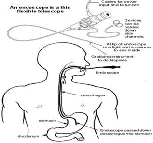 A drawing of an endoscope in the oesophagus