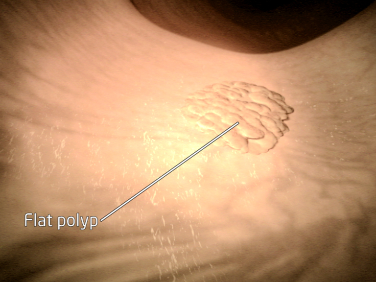a flat polyp in the bowel