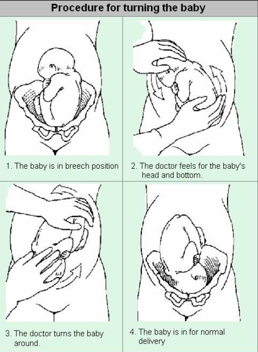 A series of line drawings showing the four stages of turning a baby in the breech position.
It starts with the baby in the breech position, then shows a doctor using their hands to find the baby's head and bottom and gently moving the baby around, so they are head down.
