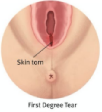A diagram showing a first degree perineal tear.
The skin directly next to the vaginal opening is torn at the point closest to the anus.