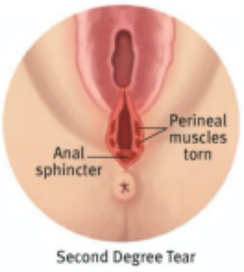 A diagram showing a second degree perineal tear.
The skin directly next to the vaginal opening and the perineal muscles are torn at the point closest to the anus. However, the tear stops prior to the anus.