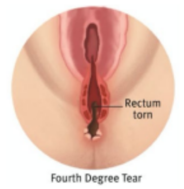 A diagram showing a fourth degree perineal tear.
The tear goes through the skin directly next to the vaginal opening, the perineal muscles, the ring-shaped muscle surrounding the anus (sphincter) and into the anus.