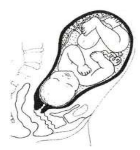 A cross section of a baby in the womb.
They are head down and the cervix is long, firm and closed