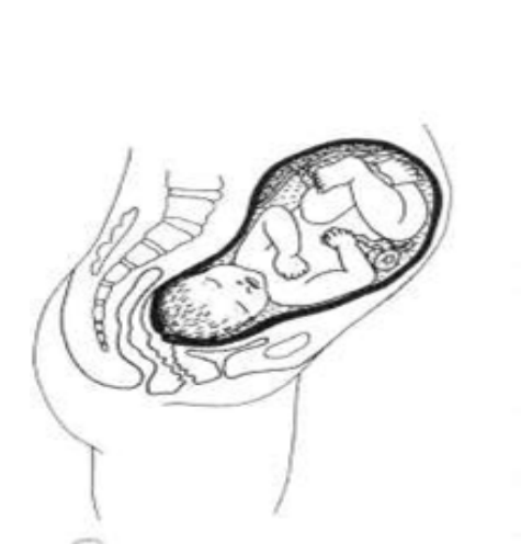 A cross section of the womb. The baby is head down but the cervix is now drawn up and is thinner