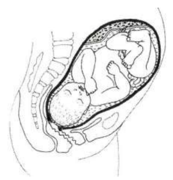 A cross section of the womb. The baby is head down and the cervix is starting to dilate