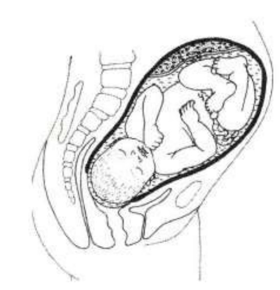 A cross section of the womb. The baby is head down and the cervix is fully dilated