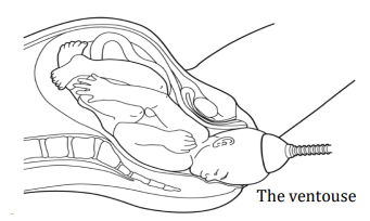 A  cross section diagram showing a baby being born using ventouse. 
The cup is attached to the top of the baby's head