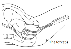 A  cross section diagram showing a baby being born using forceps. 
The forceps are placed around the sides of the baby's head