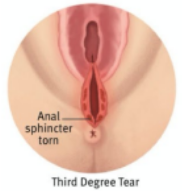 A diagram showing a third degree perineal tear.
The skin directly next to the vaginal opening, the perineal muscles and the ring-shaped muscle surrounding the anus (sphincter) are torn.