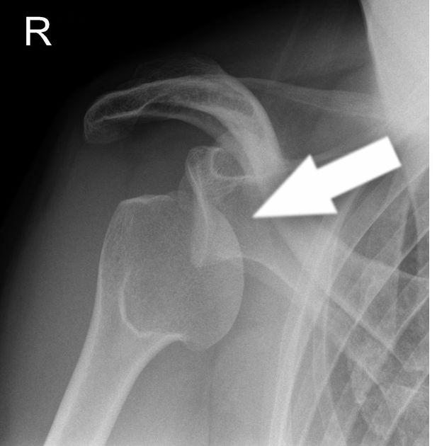 An X-ray of an anterior shoulder dislocation
