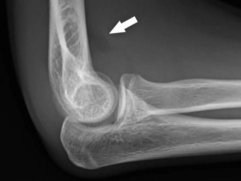 An X-ray of a fat positive elbow injury