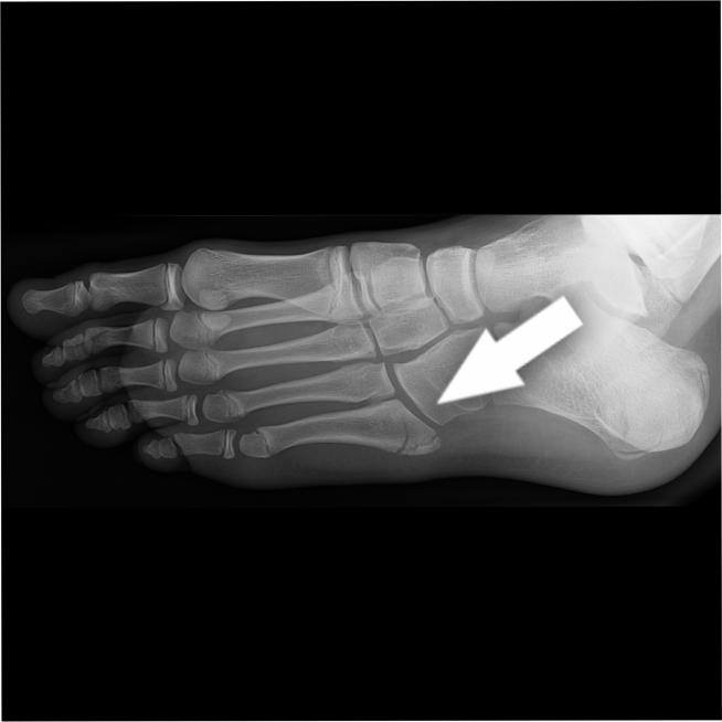 An X-ray of an isolated 5th metatarsal fracture