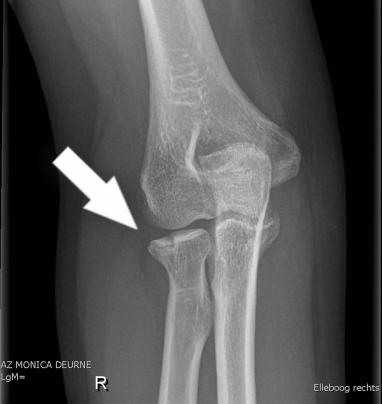 An X-ray of a minimally displaced radial head and neck fracture