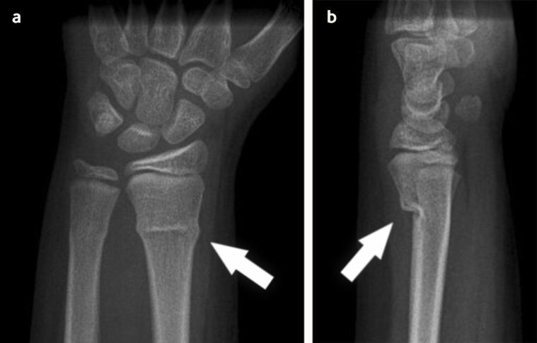 an xray of a fracture