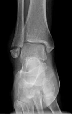 a x ray of a fractured ankle