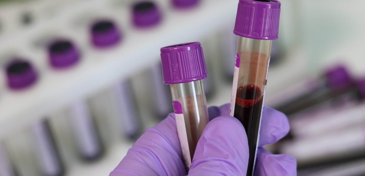 A gloved hand holding two blood samples